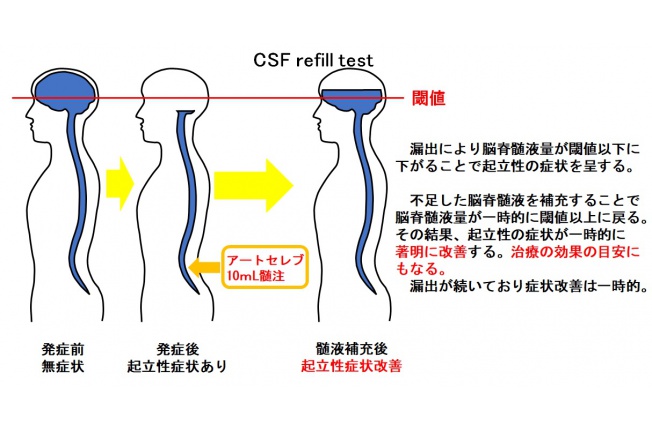 CSF%20refill%20test.jpg